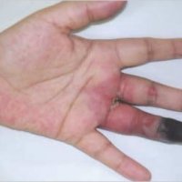 Erythematous-nodules-on-palm-and-ischemic-change-of-the-distal-phalanx-of-the-left-4th_Q640.jpeg